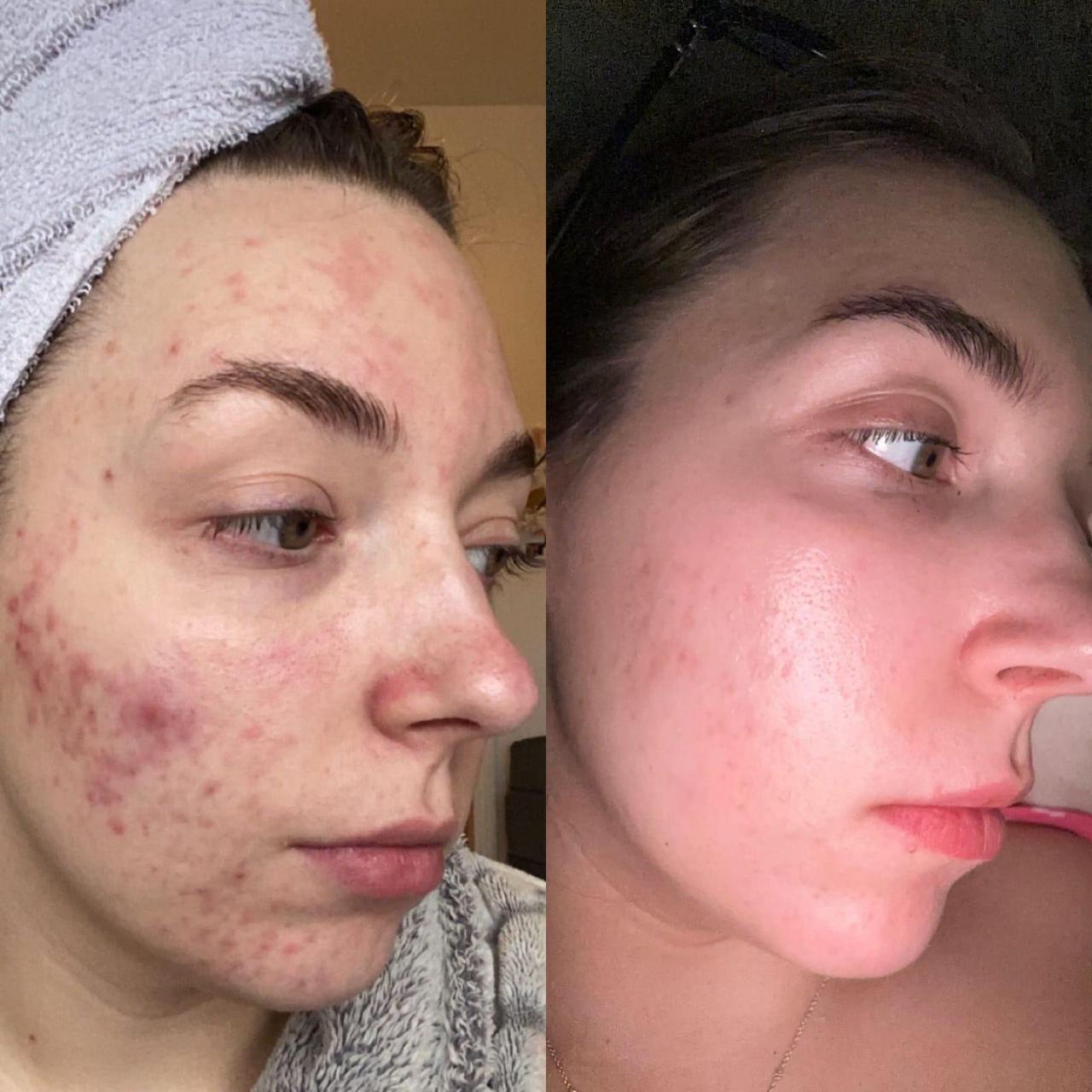 Active acne and post-inflammatory marks — before and after Fusion 8 acne protocol