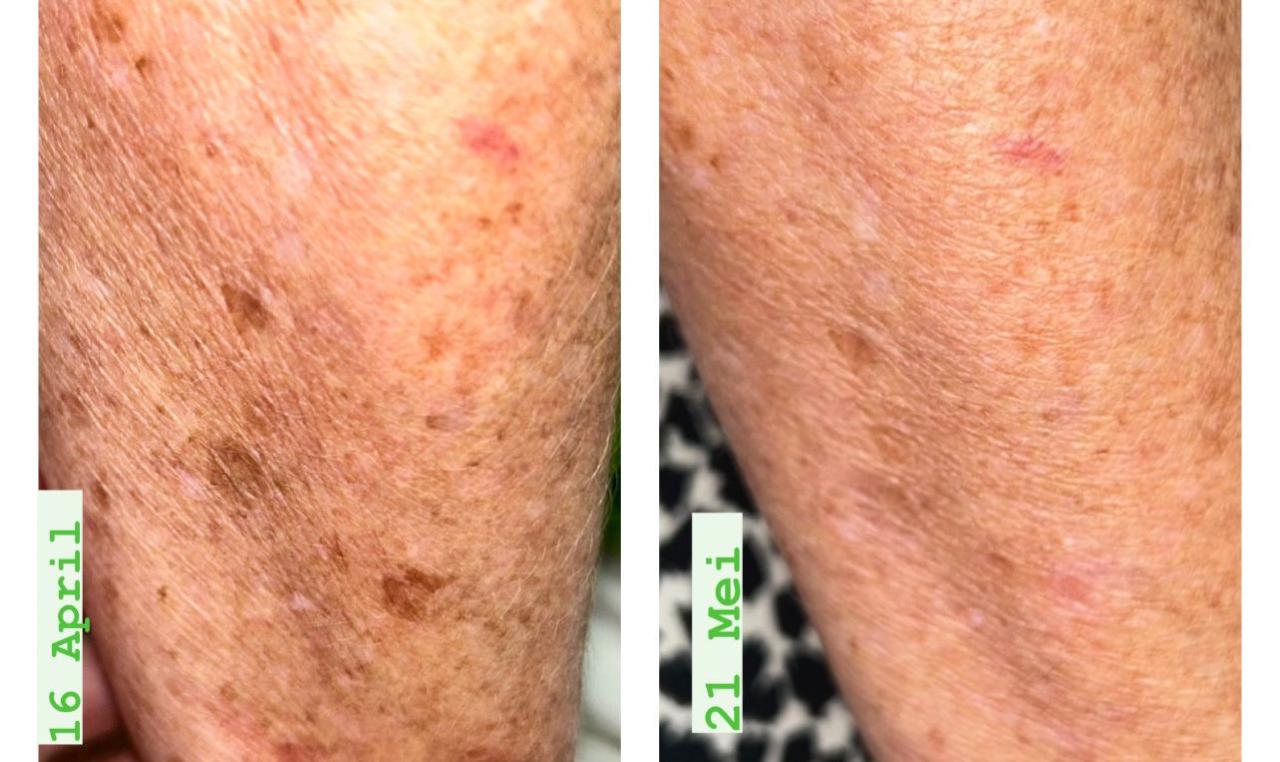 Arm sun damage and age spots — before and after IPL