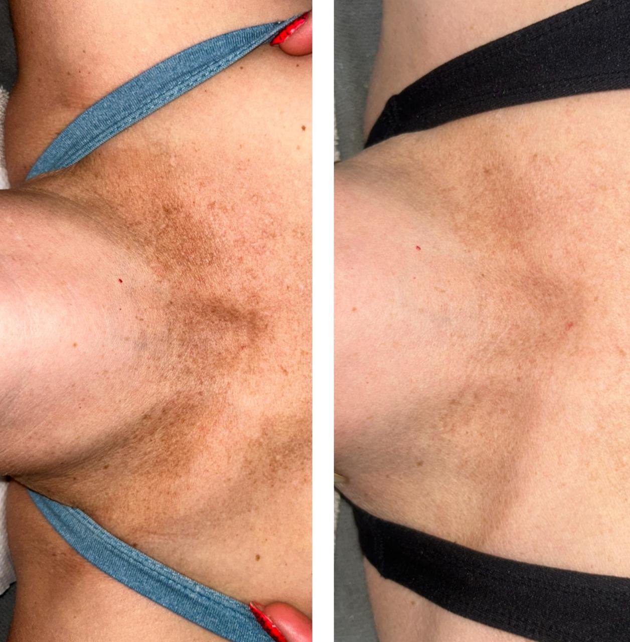 Décolleté pigmentation — before and after IPL
