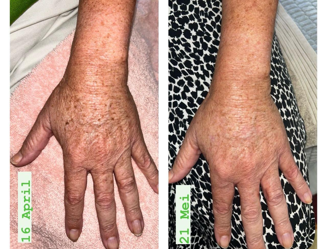 Hand sun damage — before and after IPL