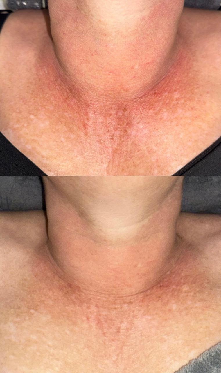 Neck rosacea and redness — before and after IPL