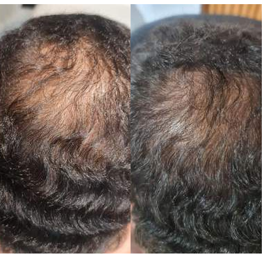 Scalp restoration — before and after