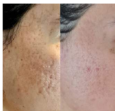 Pigmentation lifting — before and after