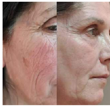 Rosacea calming — before and after
