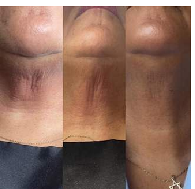 Skin smoothing — before and after